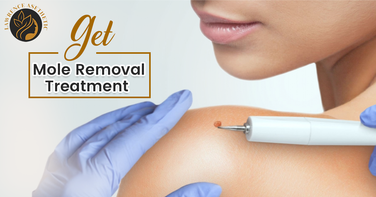 Get Mole Removal Treatment